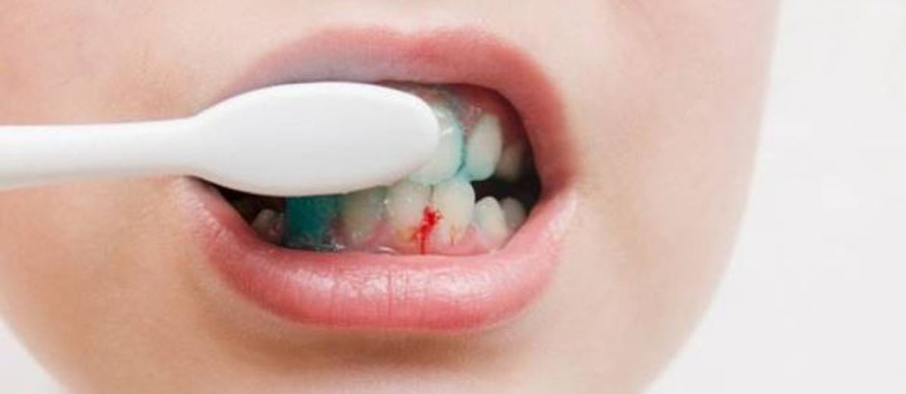 Diş Eti Kanaması Neden Olur?