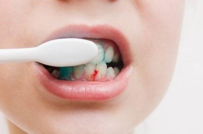 Diş Eti Kanaması Neden Olur?